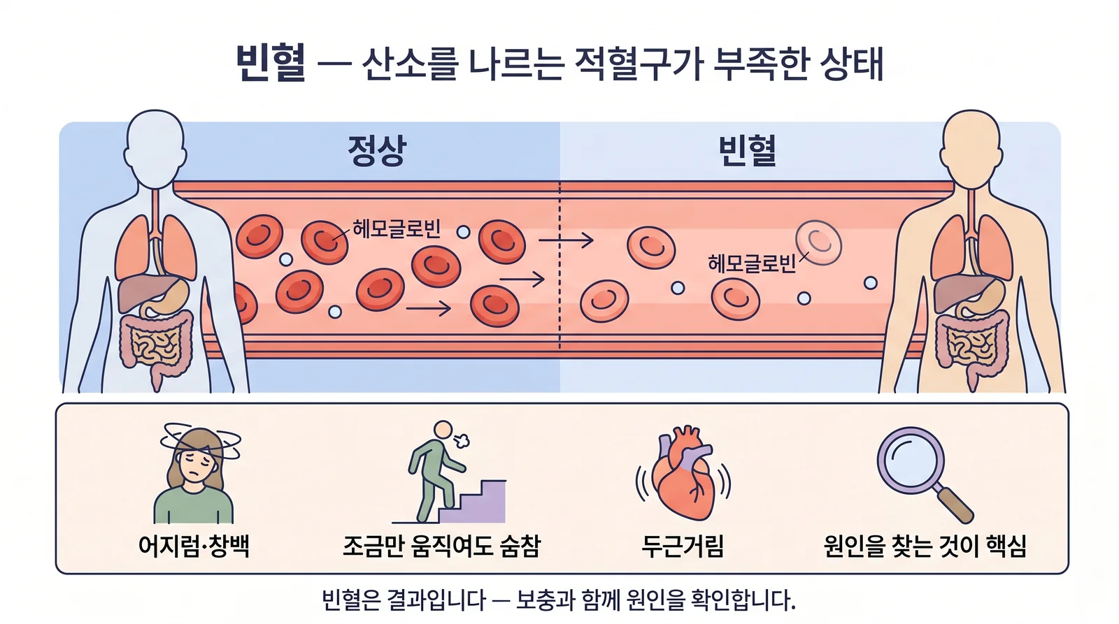 빈혈 — 안내 일러스트