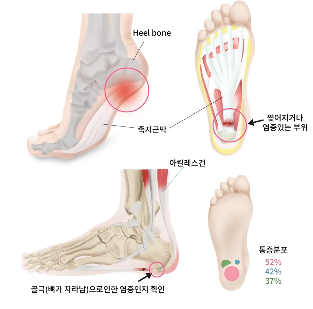 발바닥 아치를 지지하는 족저근막과 발뒤꿈치·아킬레스건 구조를 표현한 일반 안내 일러스트