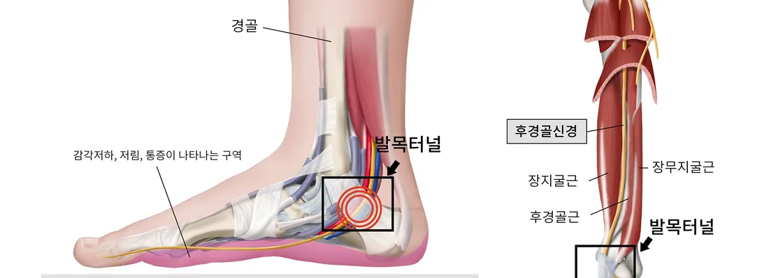 발목 안쪽 통로를 지나는 신경의 위치를 표현한 일반 안내 일러스트