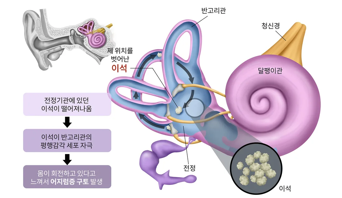 반고리관에서 이석이 제 위치를 벗어나 어지럼이 생기는 과정을 표현한 일반 안내 일러스트