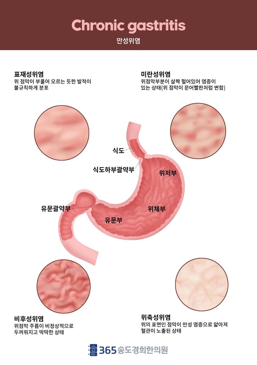만성 위염 분류 안내 자료