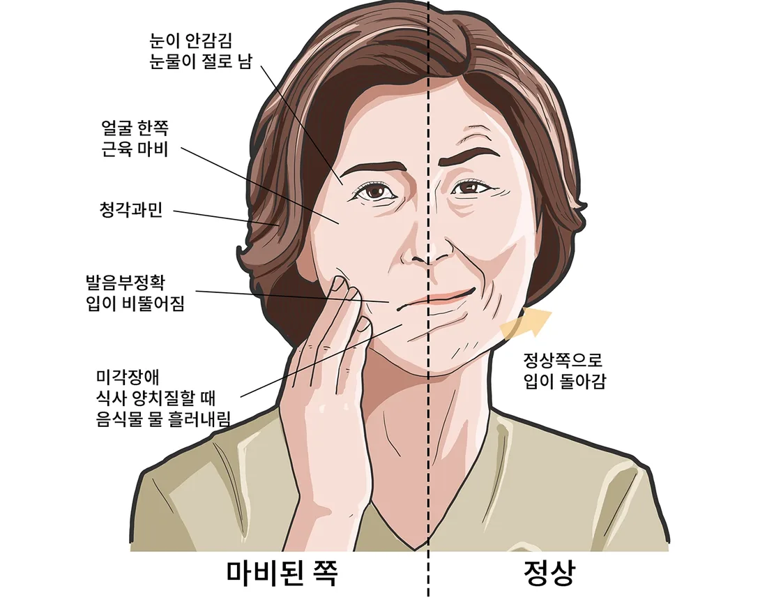 안면 한쪽 근육이 마비되어 눈 감기·입 모양·표정이 달라지는 모습을 정상 쪽과 비교한 일반 안내 일러스트