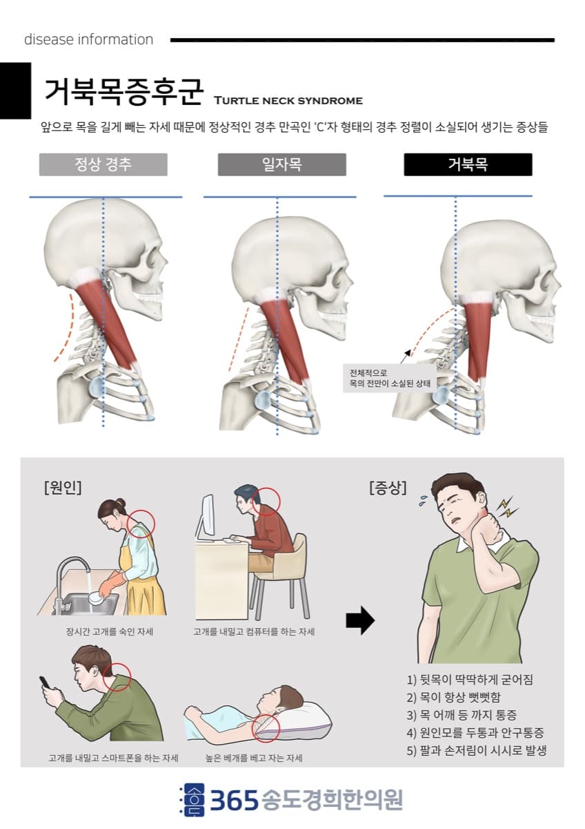 거북목 관련 안내 이미지