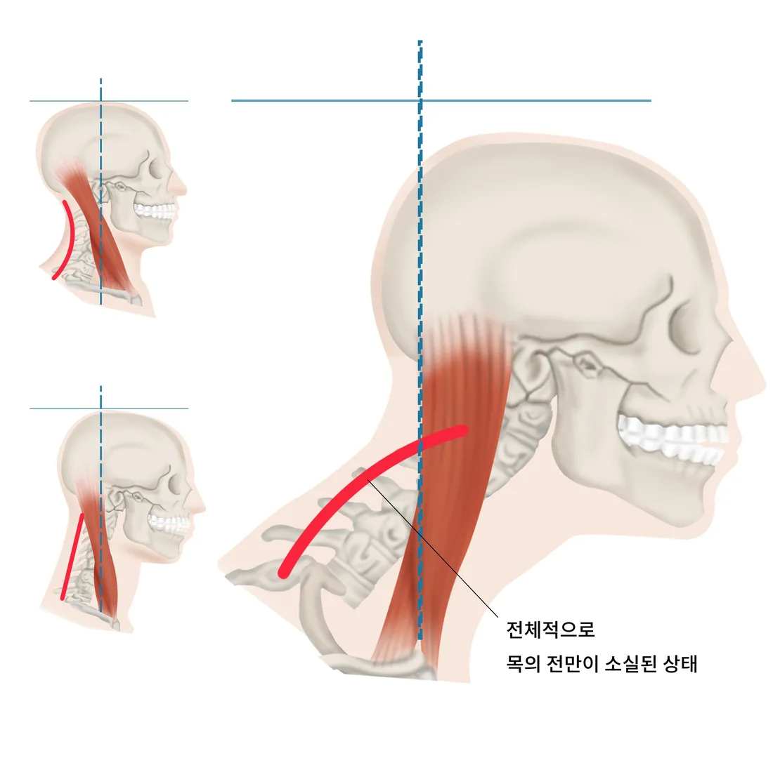 정상 경추 정렬과 거북목 자세에서 목 만곡이 무너진 모습을 비교한 일반 안내 일러스트