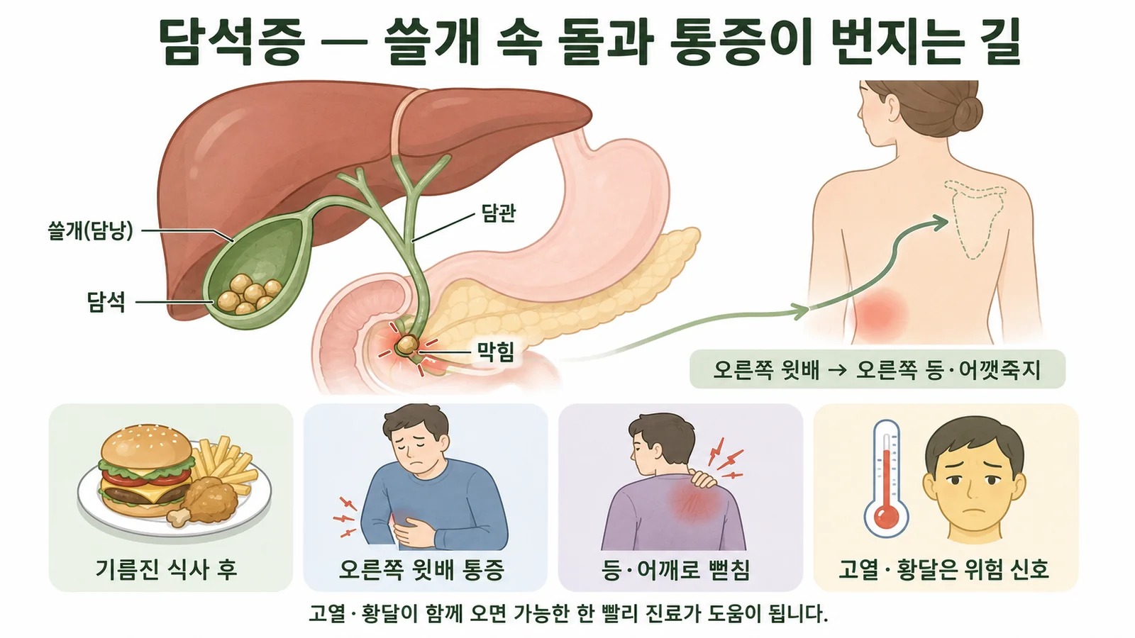 담석증 — 안내 일러스트
