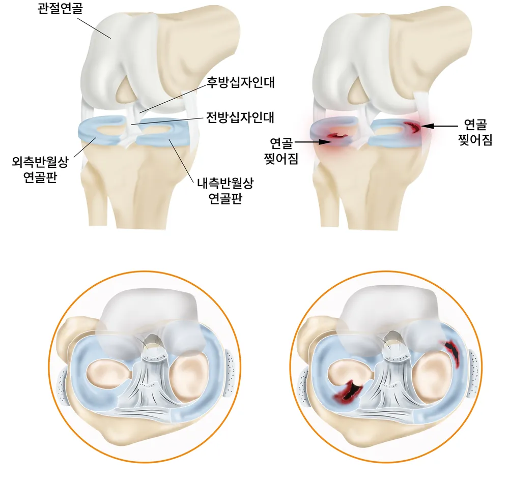 무릎 관절의 반월상 연골판과 십자인대 구조, 연골 손상 부위를 표현한 일반 안내 일러스트