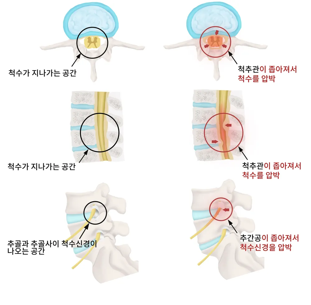 척추관과 추간공이 좁아져 척수·신경이 지나가는 공간이 줄어드는 모습을 정상과 비교한 일반 안내 일러스트