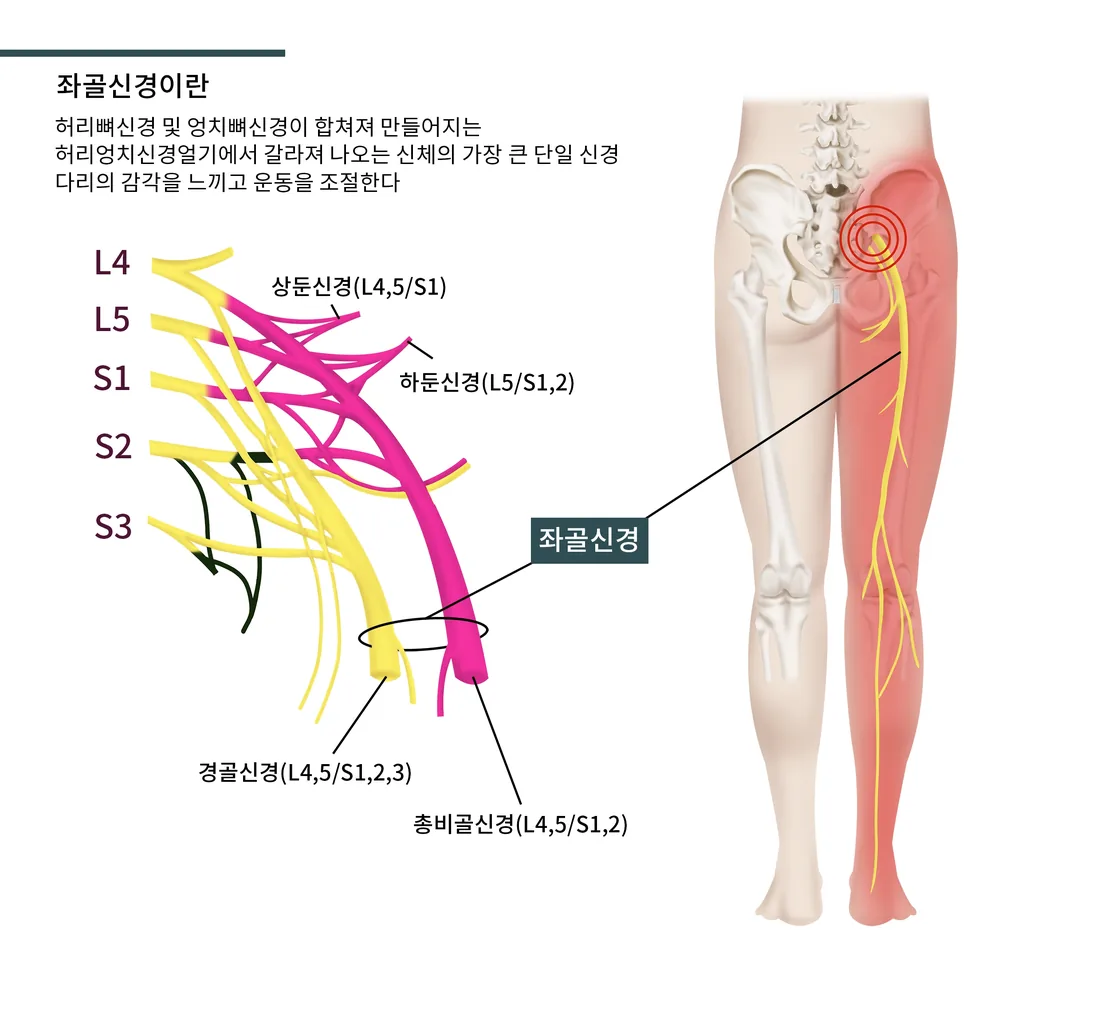 허리·엉덩이에서 다리로 이어지는 좌골신경의 경로와 분지를 표현한 일반 안내 일러스트