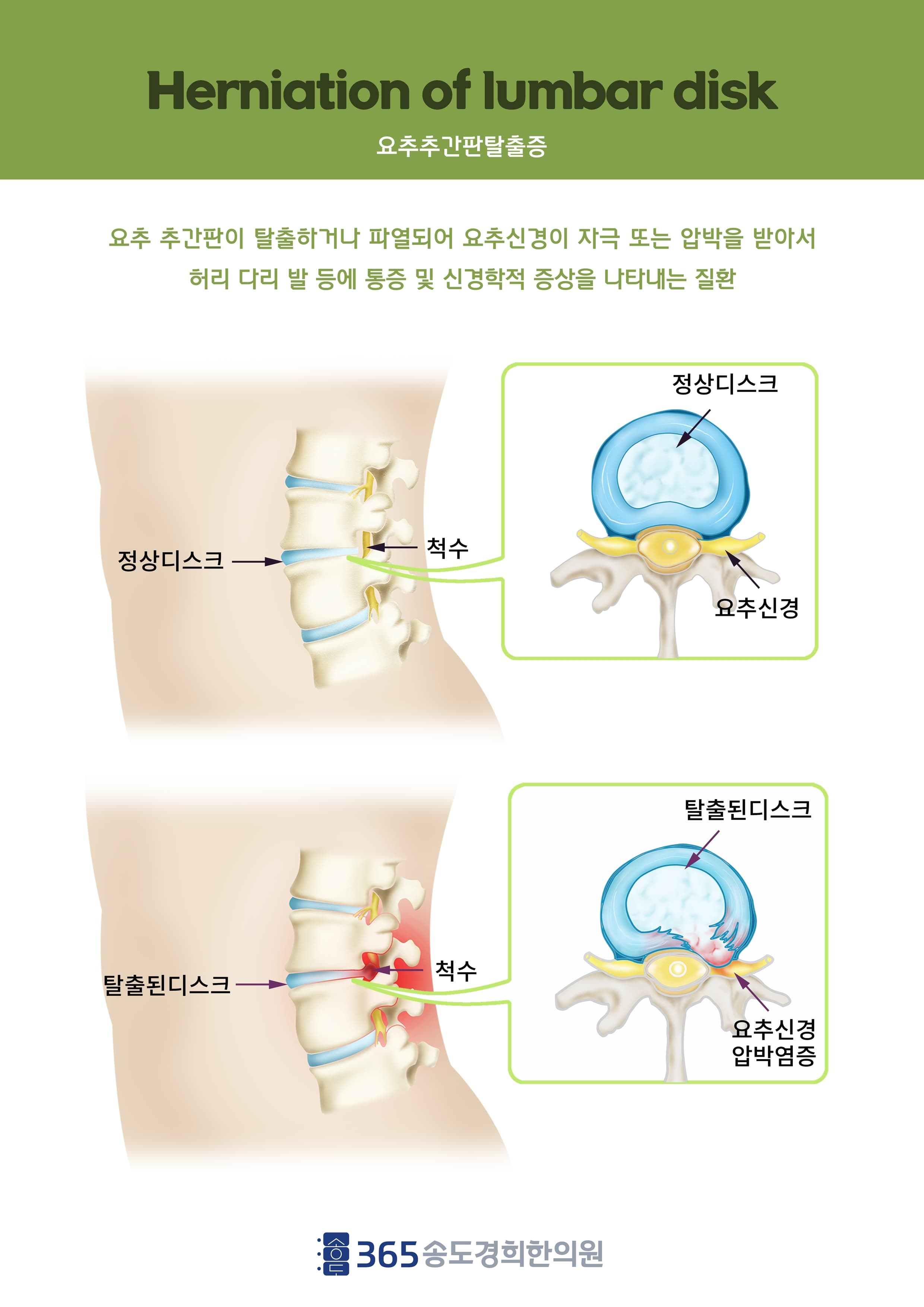 요추 디스크 일러스트