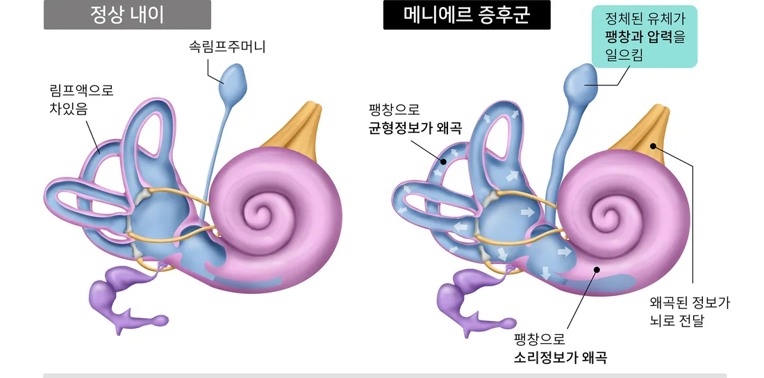 정상 내이와 메니에르 내이의 내림프 상태 차이를 비교한 일반 안내 일러스트