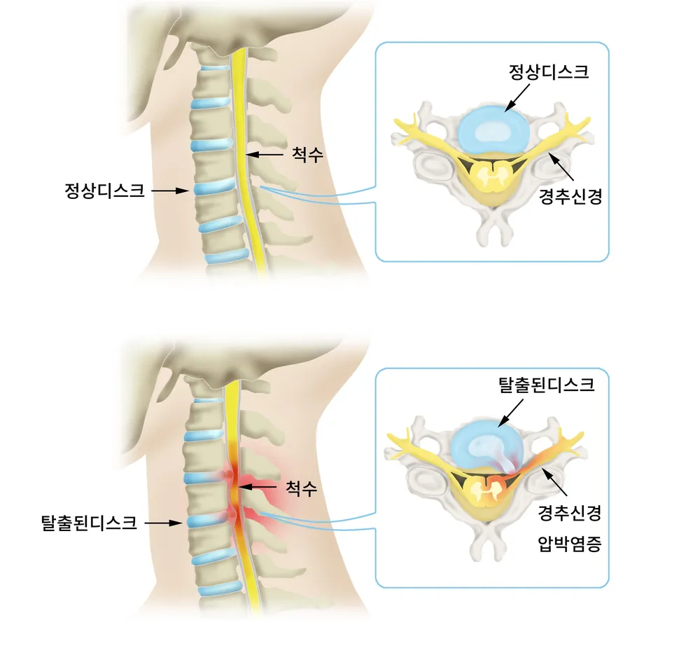 정상 경추 디스크와 탈출된 디스크가 척수·경추신경에 미치는 모습을 비교한 일반 안내 일러스트