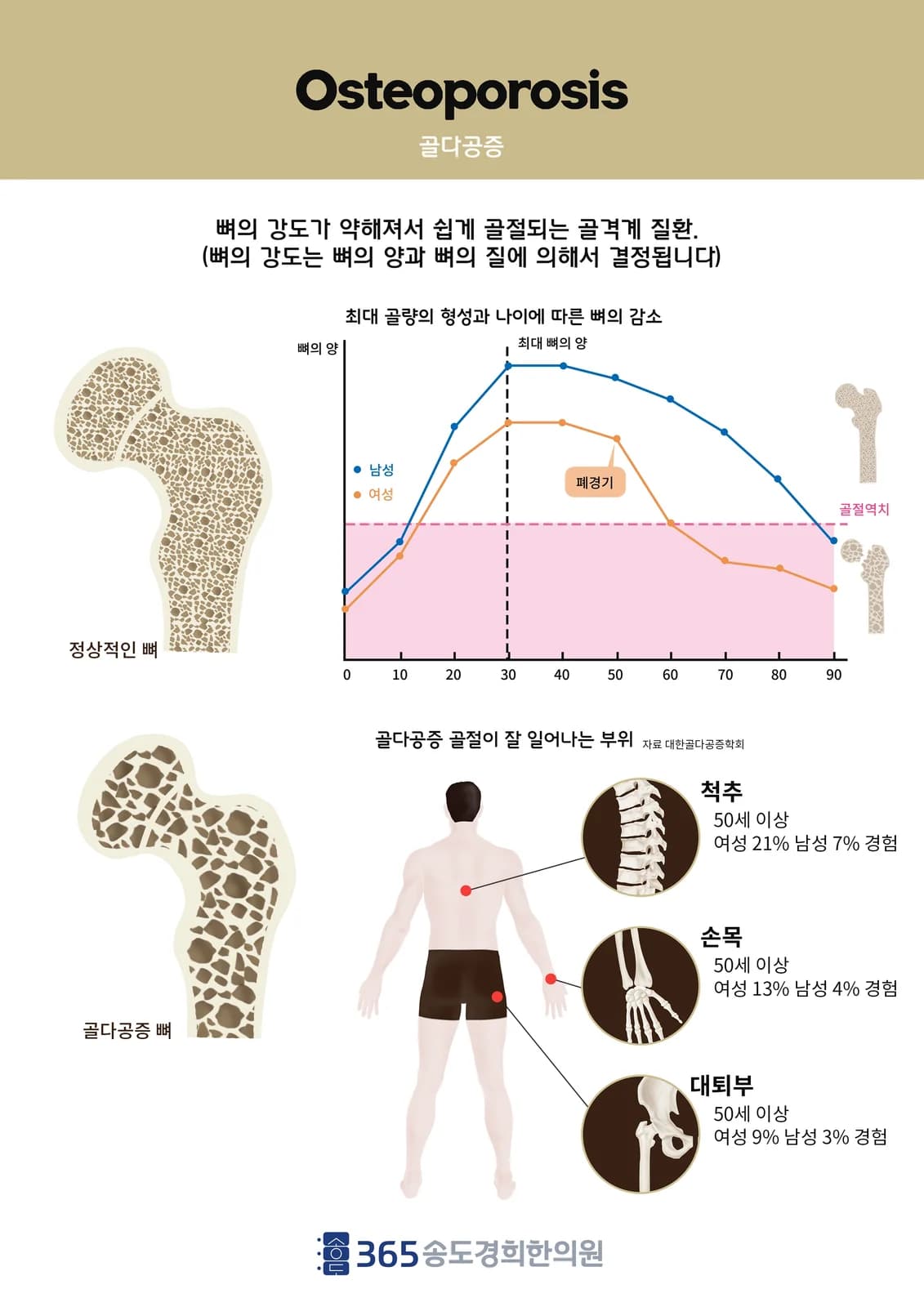골다공증 — 뼈의 변화와 골절 예방 안내 일러스트