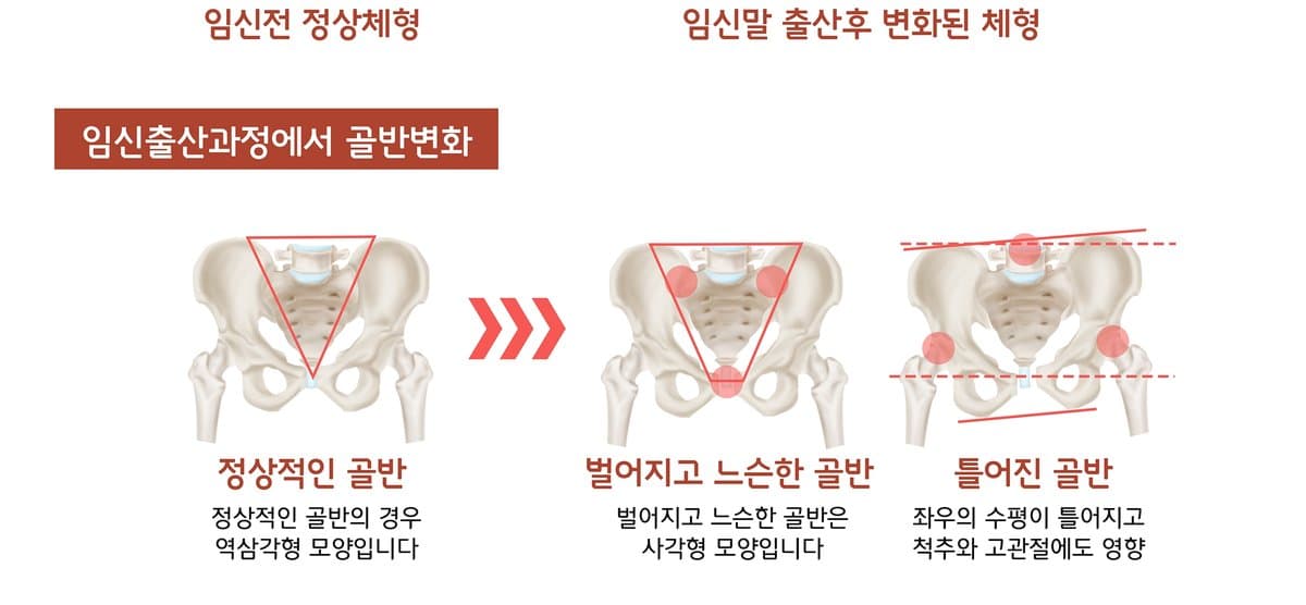 산후 체형·골반 변화 안내 자료