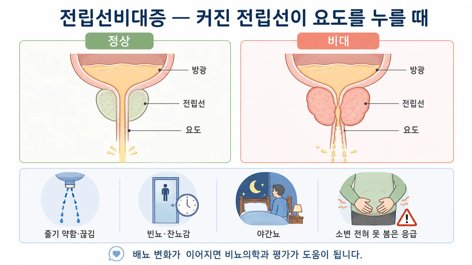 전립선비대증 — 안내 일러스트