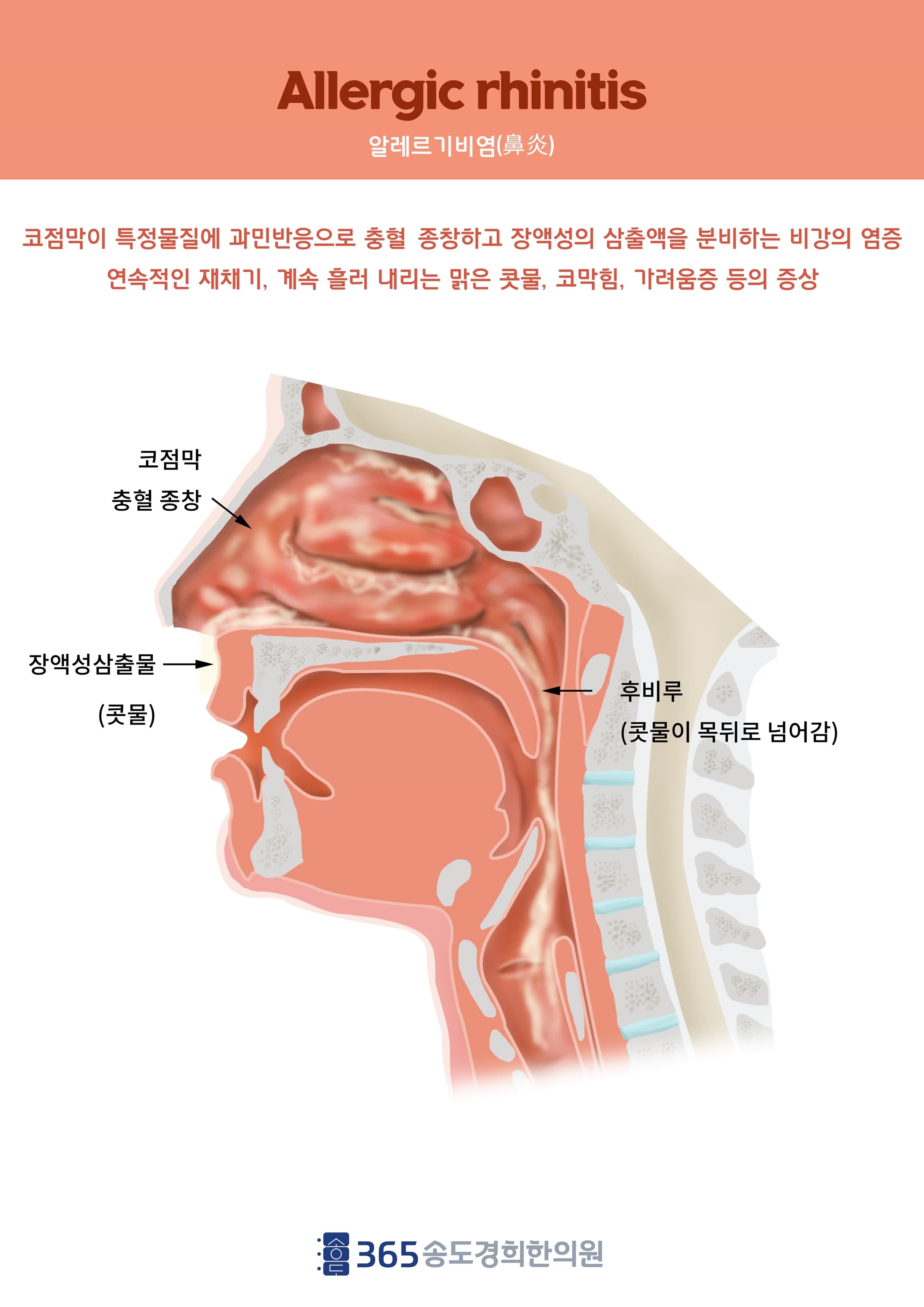 비염 일러스트