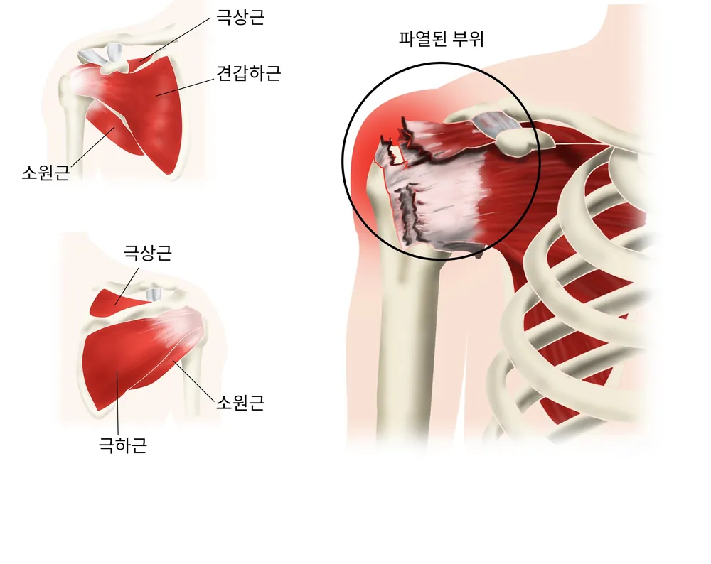 어깨 회전근개를 이루는 네 근육(극상근·극하근·견갑하근·소원근)과 힘줄 파열 부위를 표현한 일반 안내 일러스트