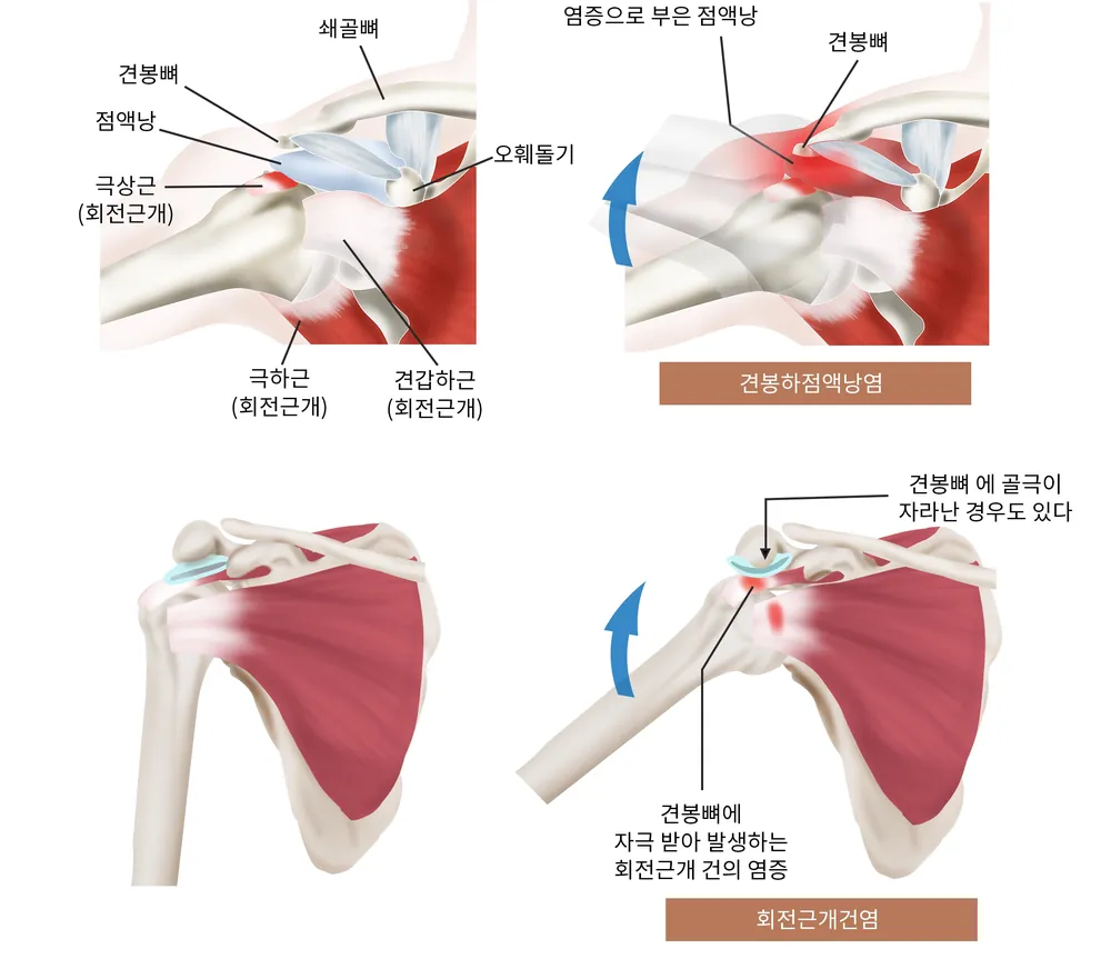 어깨 견봉 아래 공간에서 점액낭과 회전근개 힘줄이 자극받는 모습을 표현한 일반 안내 일러스트