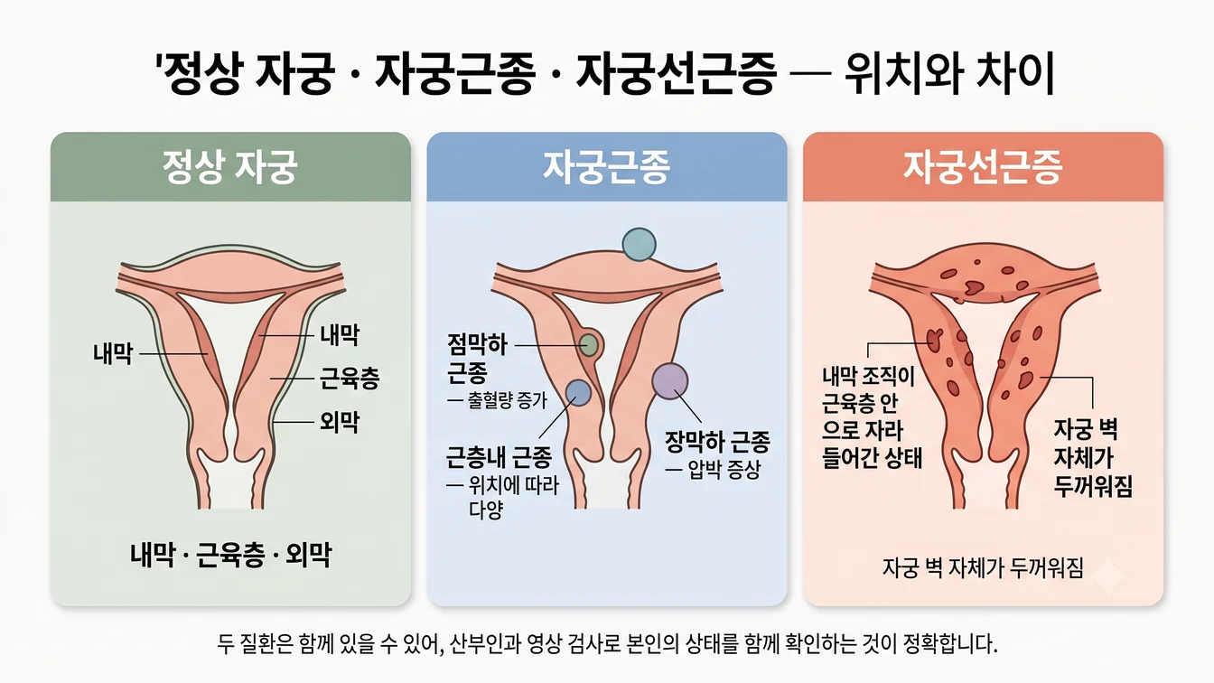 정상 자궁·자궁근종(점막하·근층내·장막하)·자궁선근증의 위치와 차이 안내