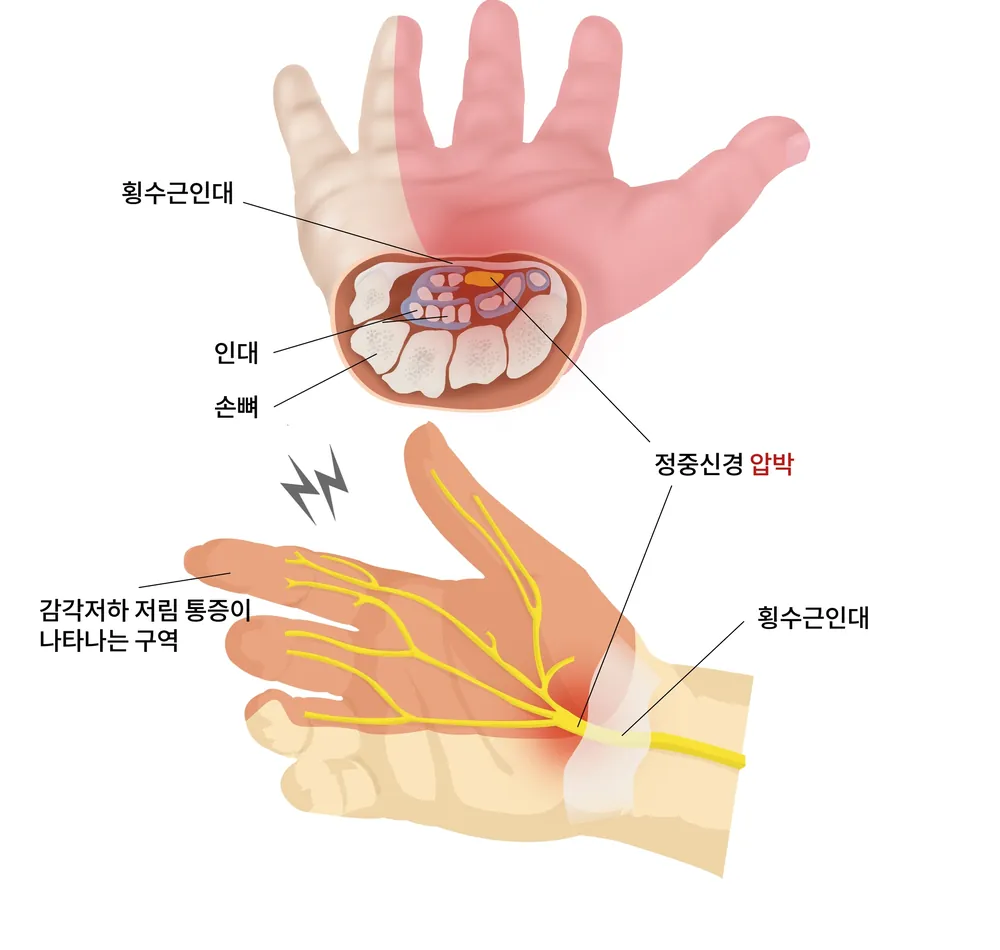 손목 앞쪽 수근관을 지나는 정중신경이 눌리는 모습과 저림이 나타나는 손 부위를 표현한 일반 안내 일러스트