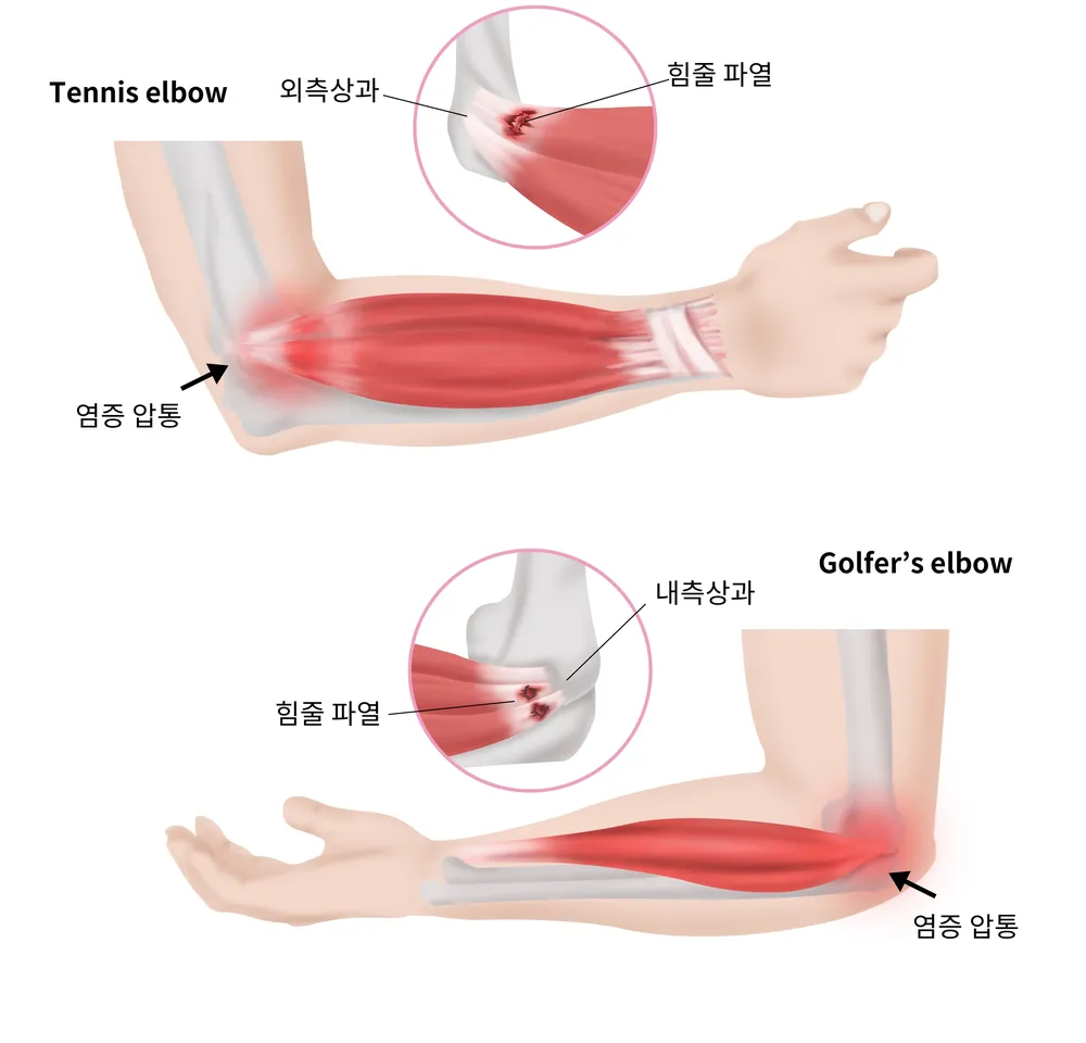 팔꿈치 바깥쪽(테니스엘보)과 안쪽(골프엘보) 힘줄이 시작되는 부위의 부담을 표현한 일반 안내 일러스트