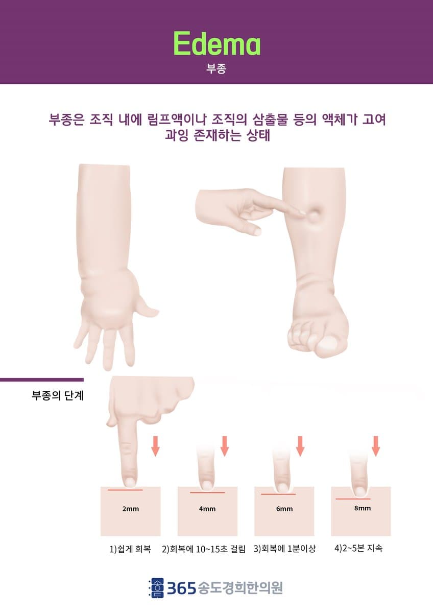 부종 단계 안내 자료