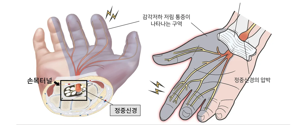 손목 앞쪽 통로를 지나는 정중신경의 위치를 표현한 일반 안내 일러스트