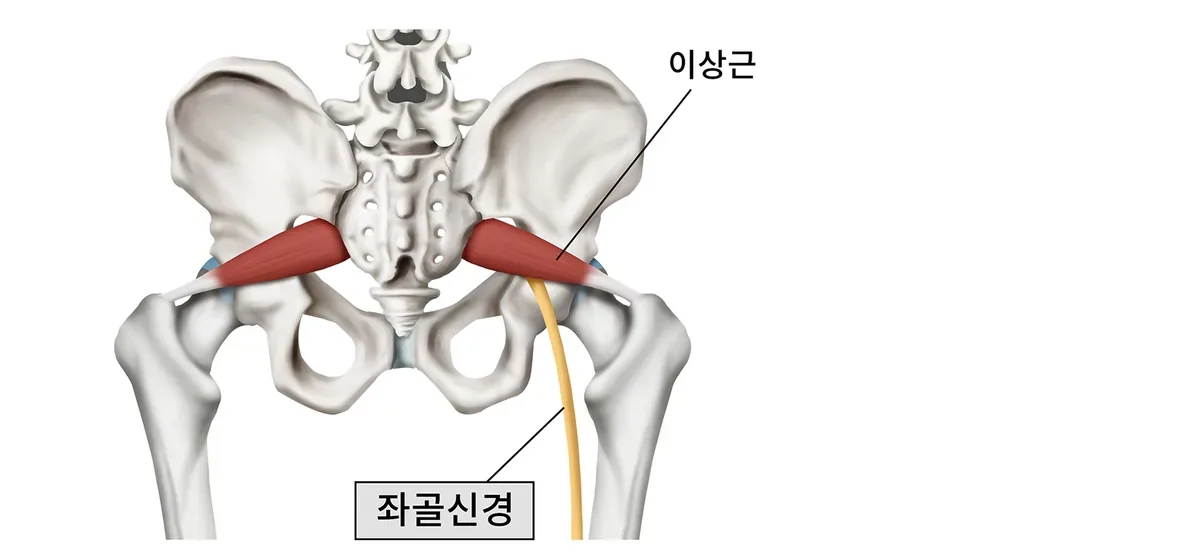 엉덩이 깊은 근육과 좌골신경의 위치 관계를 표현한 일반 안내 일러스트
