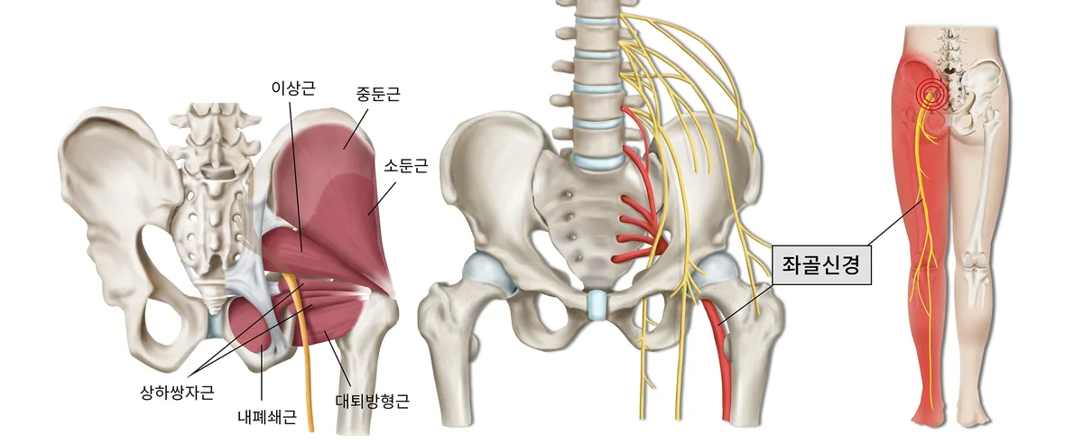 허리·엉덩이에서 다리 뒤쪽으로 이어지는 좌골신경의 분포를 표현한 일반 안내 일러스트