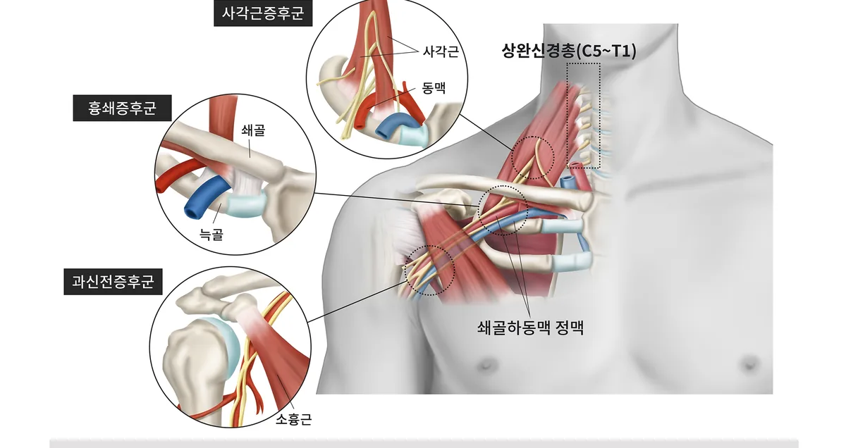 목·어깨 통로에서 팔로 이어지는 신경·혈관 영역을 표현한 일반 안내 일러스트