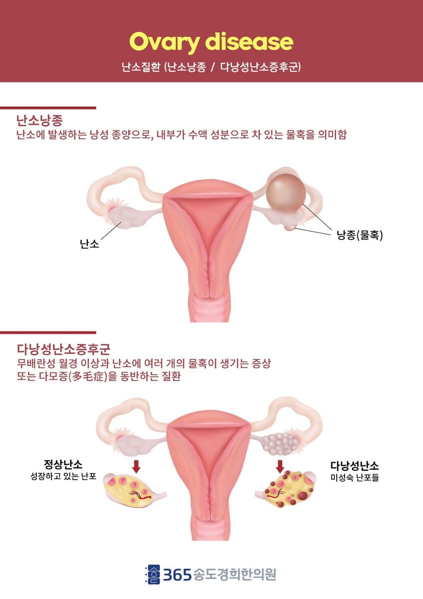 난소 해부·다낭성난소증후군 안내 자료