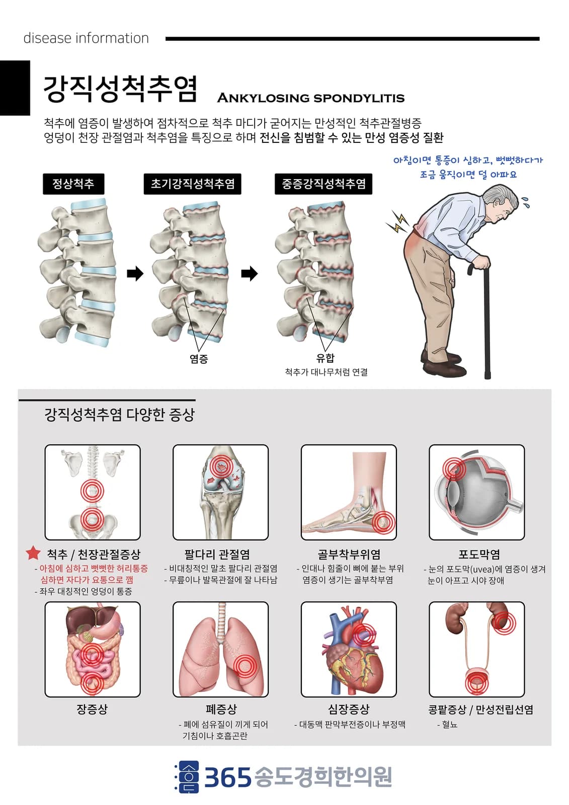 강직성 척추염 질환 설명 안내지