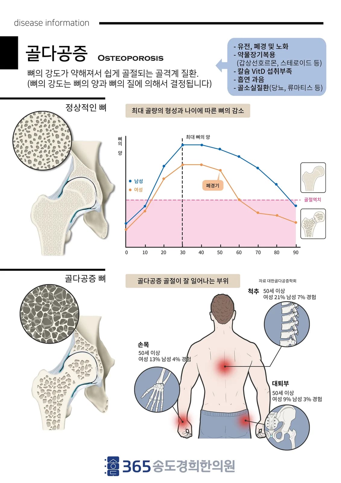골다공증 질환 설명 안내지