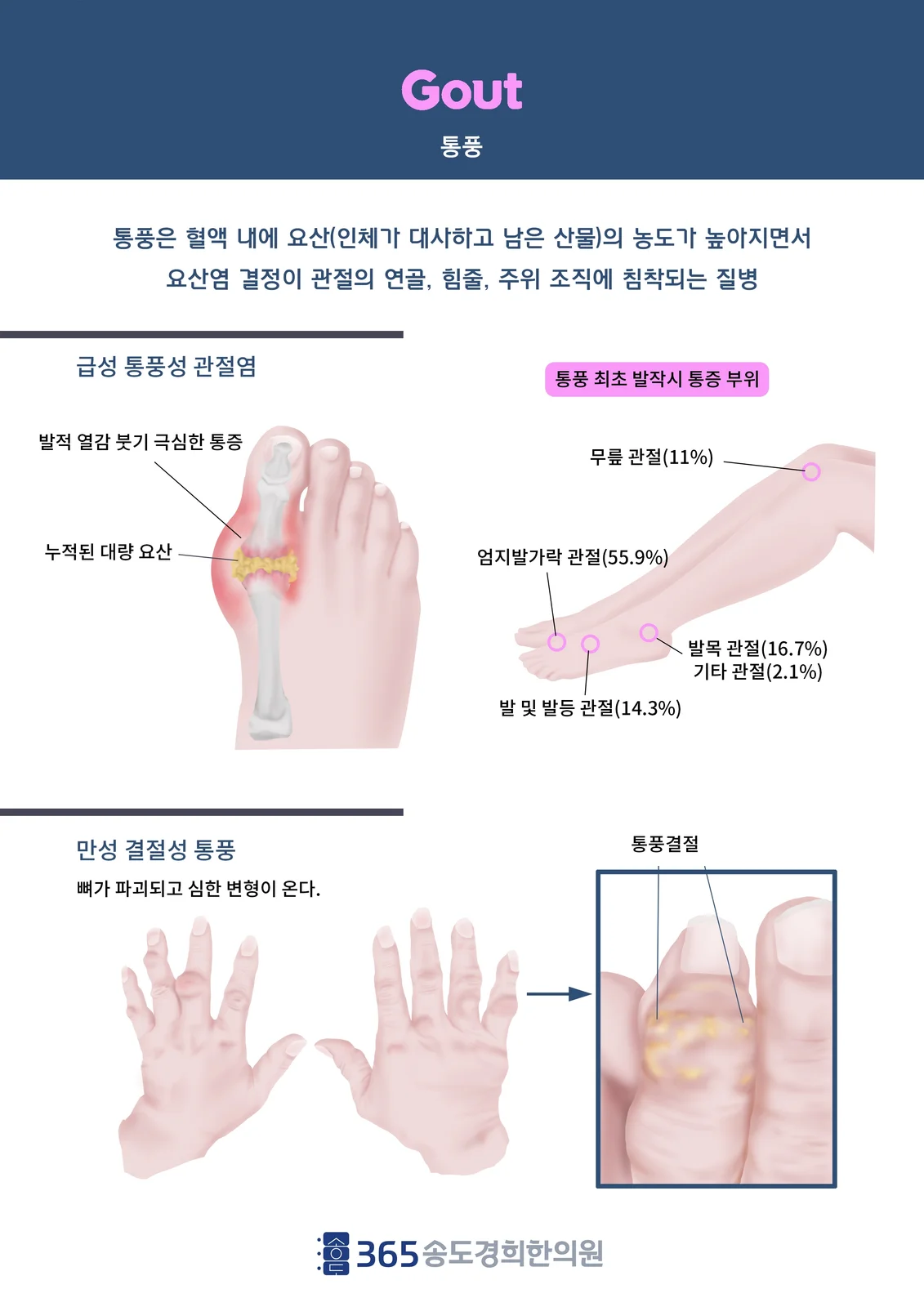 통풍 — 엄지발가락 관절의 요산 결정과 발작 안내 일러스트