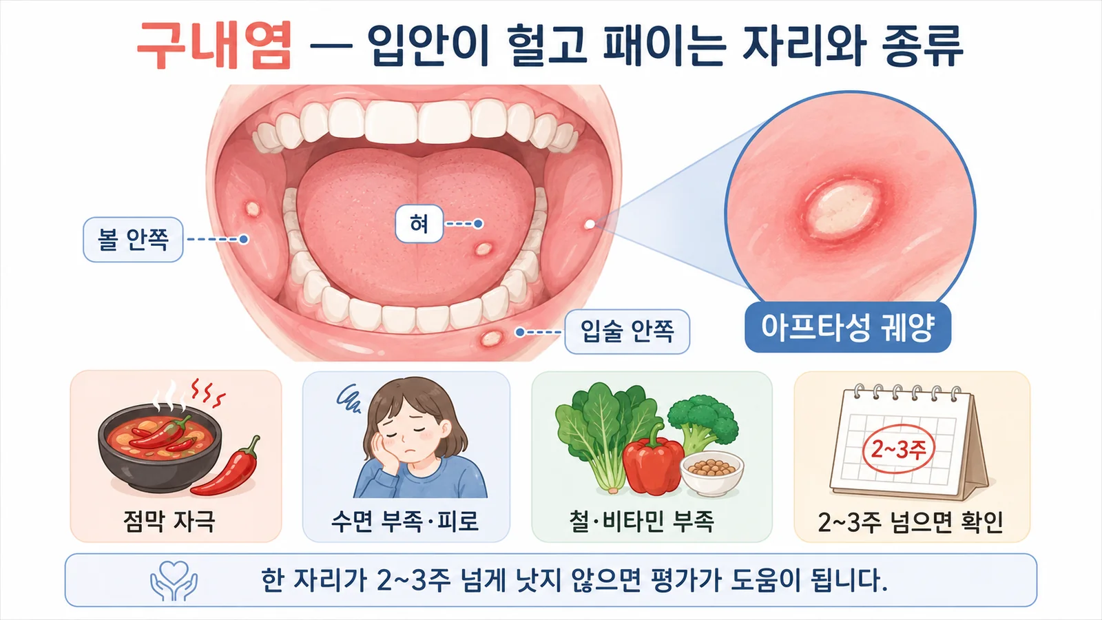 구내염 — 안내 일러스트