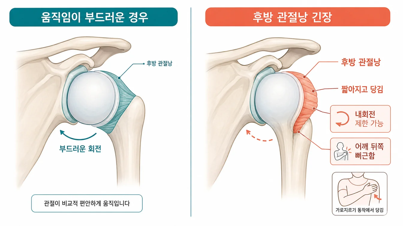 어깨 후방 관절낭과 긴장 부위를 표현한 한국어 라벨 안내 일러스트