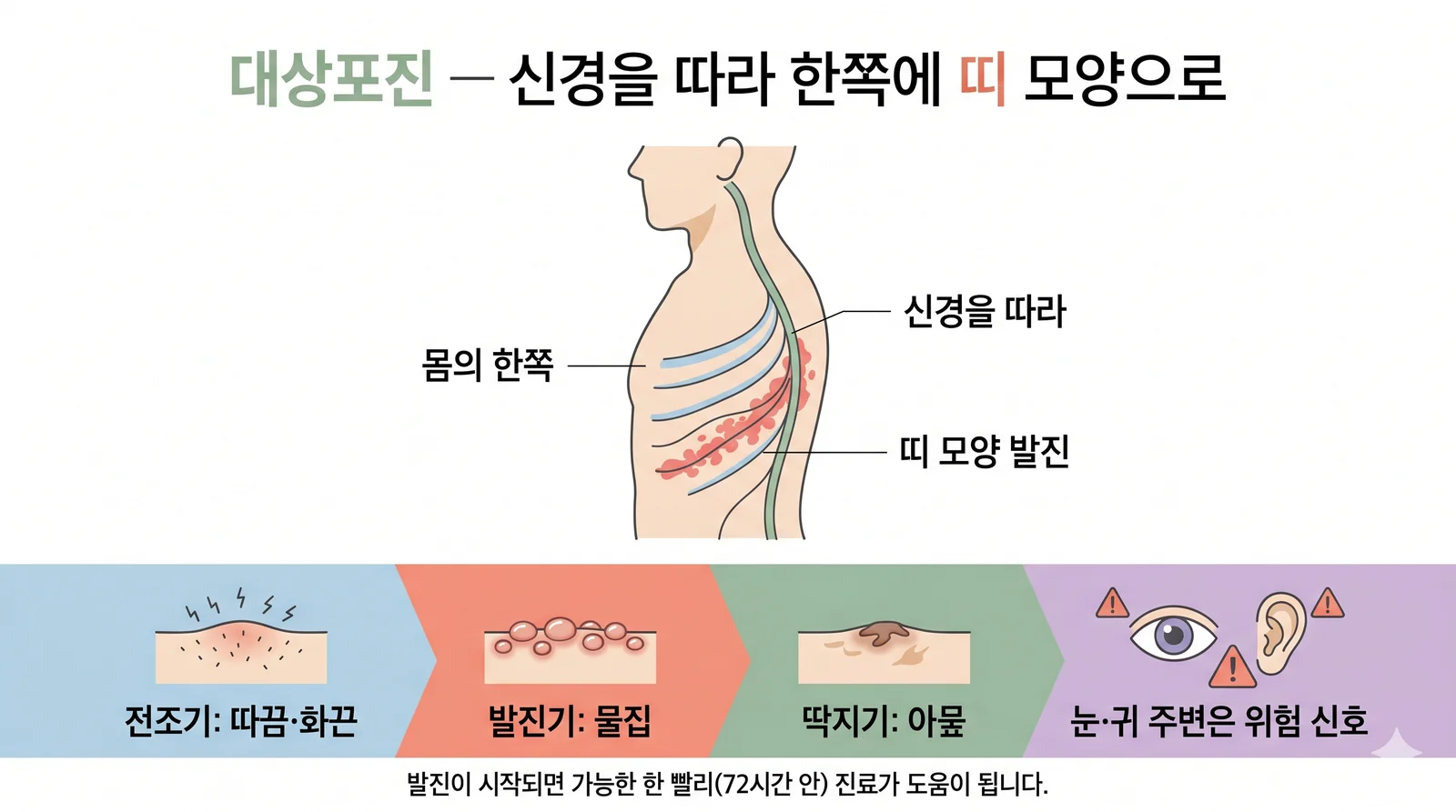 대상포진 — 안내 일러스트