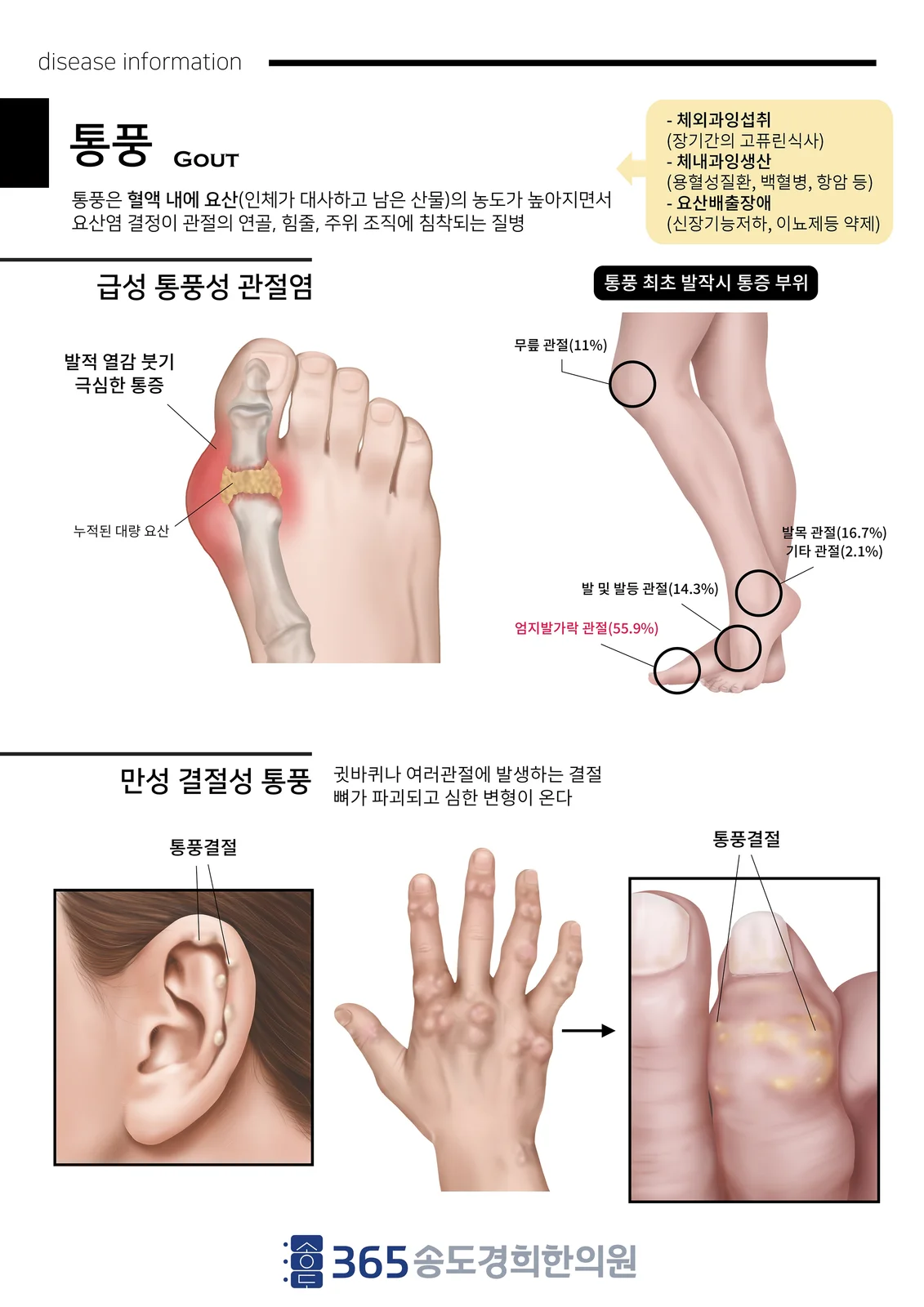 통풍 질환 설명 안내지