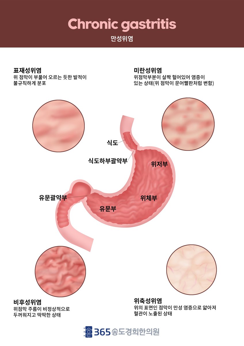 만성 위염 분류 안내 자료