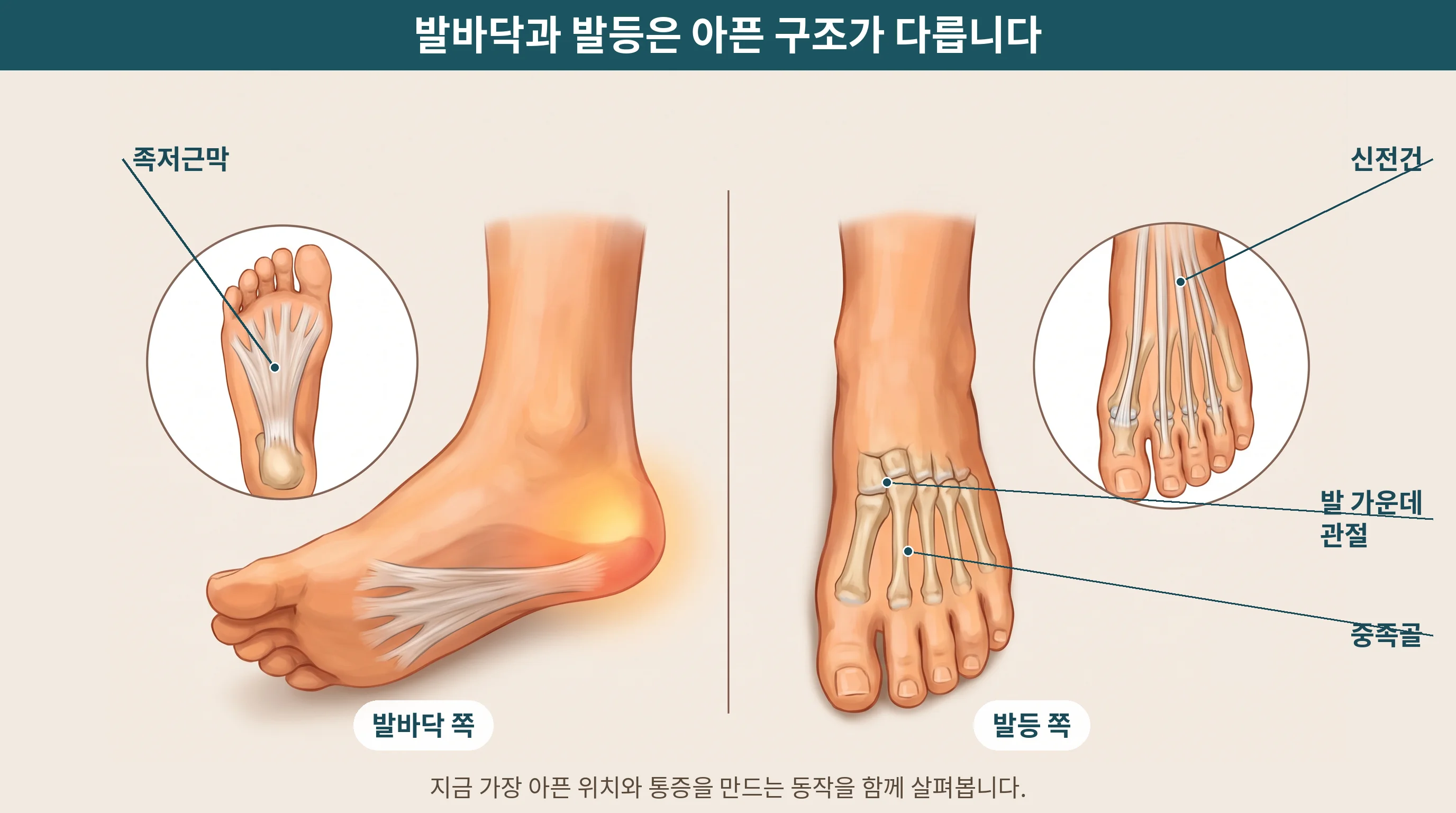 발바닥의 족저근막과 발등의 신전건·중족골·발 가운데 관절 위치를 비교해 표시한 안내 그림
