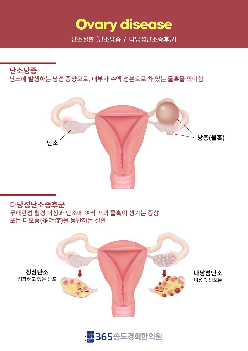 다낭성난소증후군 식사·생활